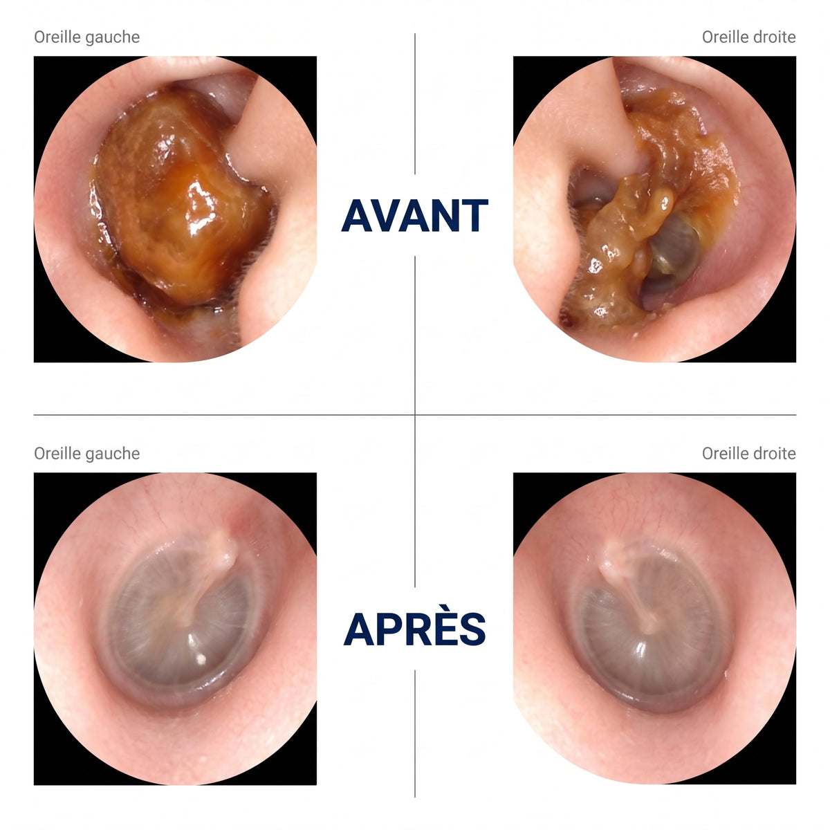 Somnalis™ — Nettoyage des oreilles précis avec caméra HD