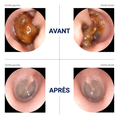 Somnalis™ — Nettoyage des oreilles précis avec caméra HD