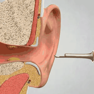 Somnalis™ — Nettoyage des oreilles précis avec caméra HD