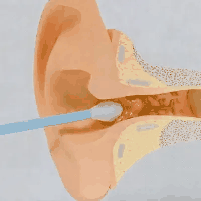 Somnalis™ — Nettoyage des oreilles précis avec caméra HD